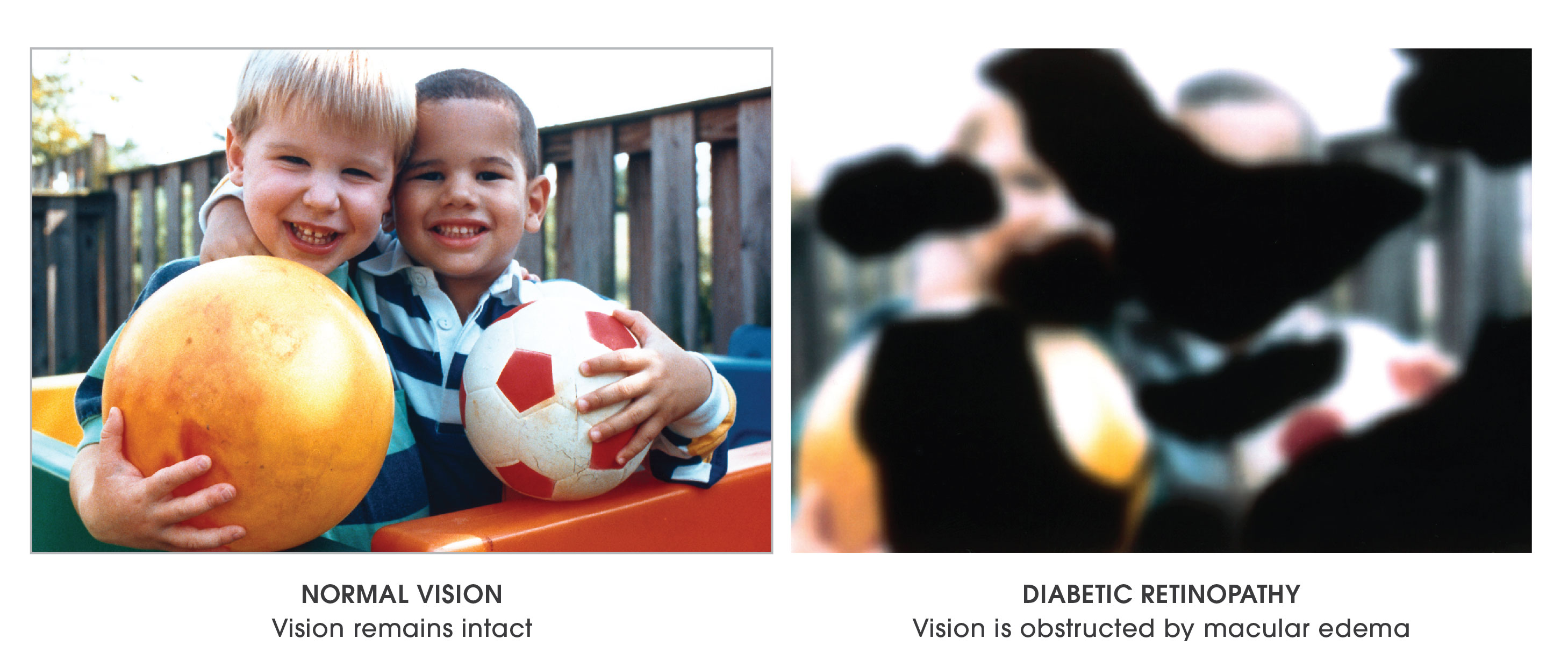Diabetic Retinopathy – Cates Family Eye Care